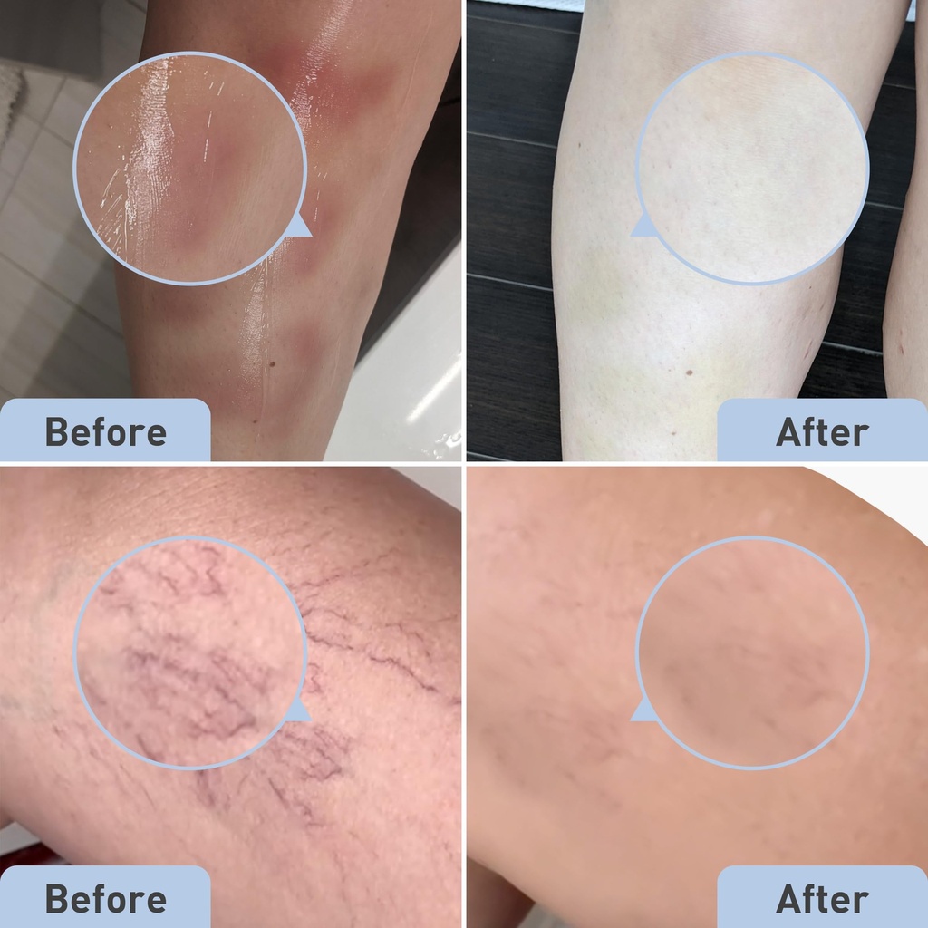 procure-bruise-remedy-gel-arnica-montana-6.jpg